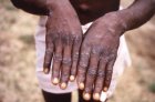 Avec l'apparition d'une épidémie mortelle de Mpox, l'insuffisance de la capacité de dépistage met les enfants en danger