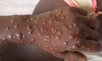 Variole du singe à Dakar : Le cas importé de Mpox est désormais guéri