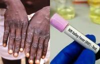 Sénégal : La Fièvre de la Vallée du Rift et le Mpox inquiètent les autorités sanitaires