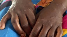 Guinée: l'épidémie de mpox s'étend dans le pays, un an après son apparition