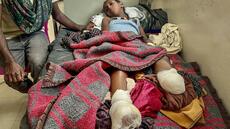 Guerre en Ethiopie: dans un hôpital de Mekele, au Tigré, des enfants amputés, la douleur partout