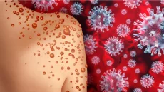 Sénégal : un deuxième cas de Mpox confirmé à Dakar