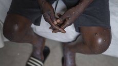 Nouveaux cas et décès : Situation préoccupante avec le Mpox et la fièvre de la Vallée du Rift